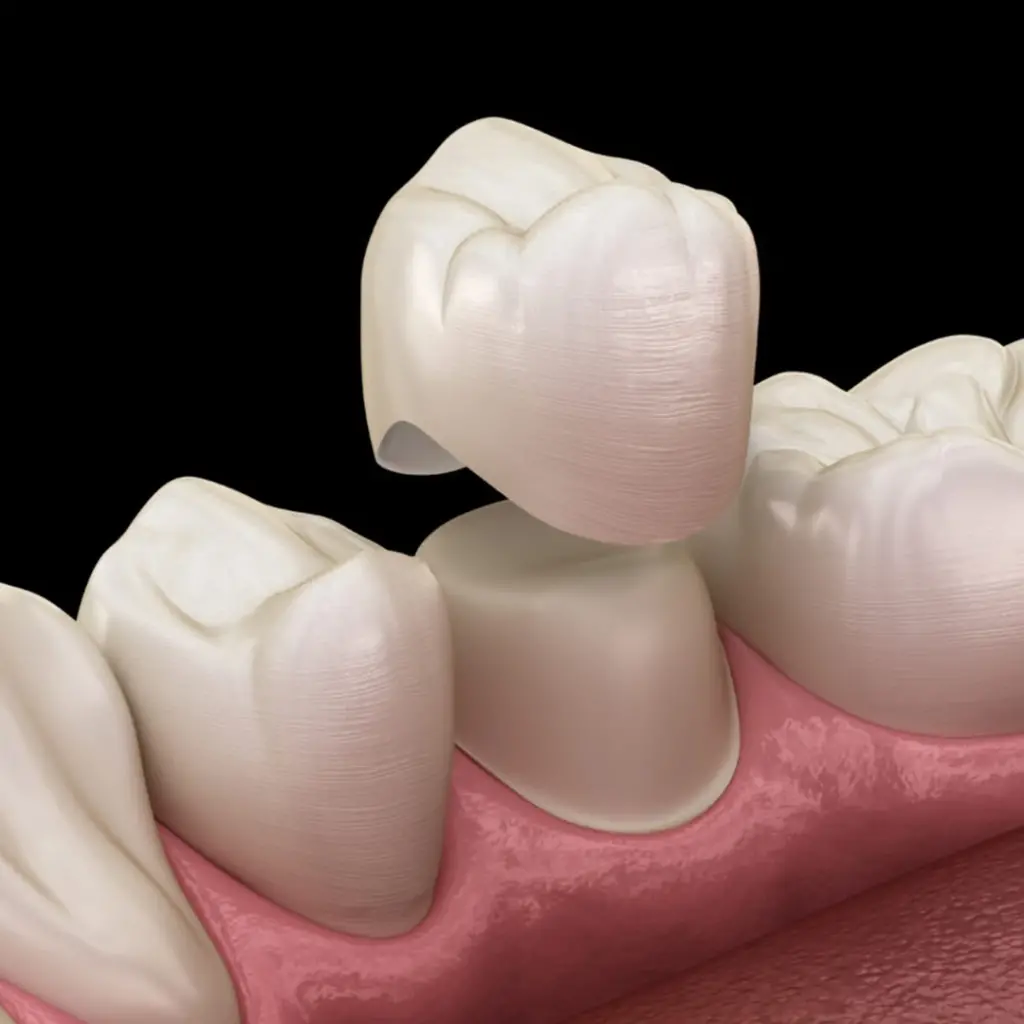 Zirconium Crown
