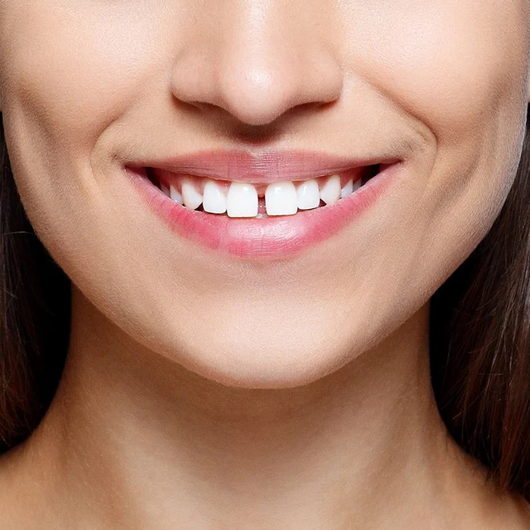 Diastema