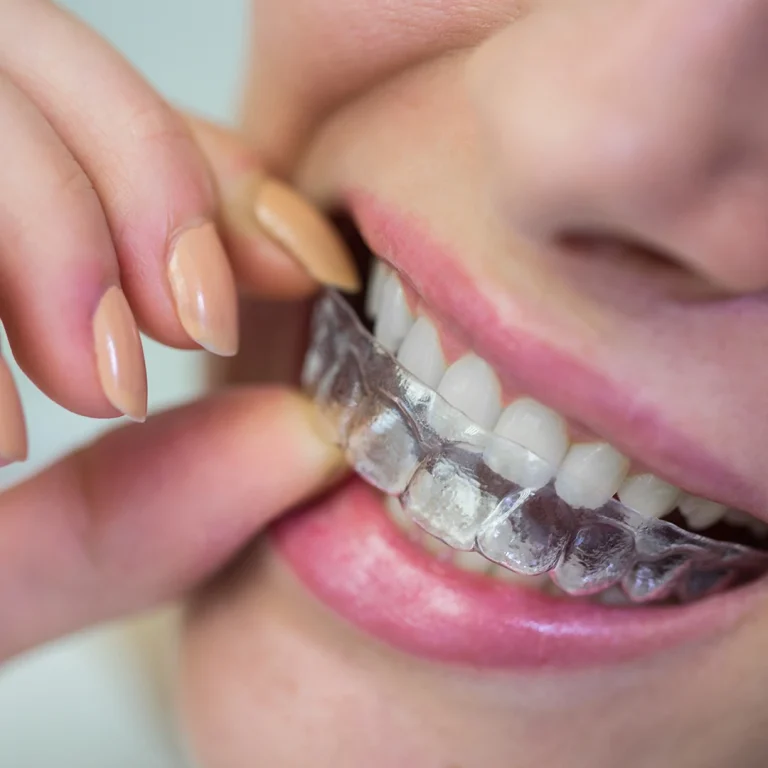 Invisalign