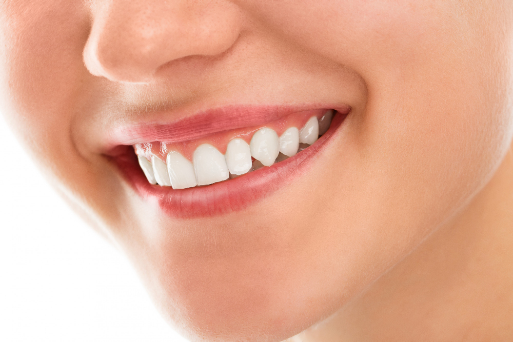 Are Veneers Permanent?