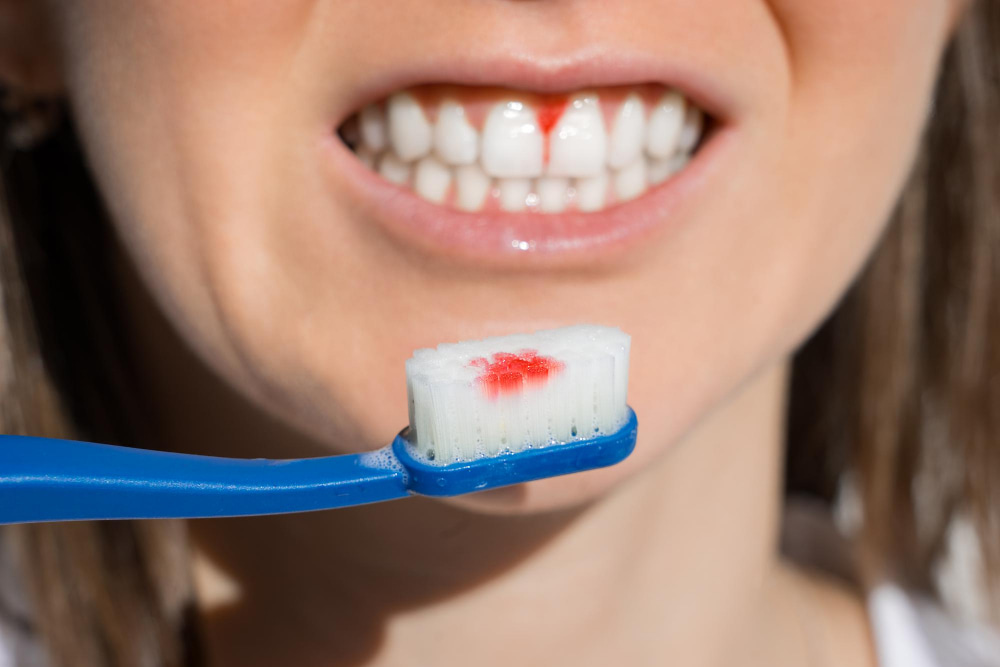 Bleeding Gums: Causes & Treatment