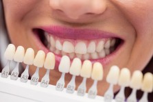 Dental Veneer Types