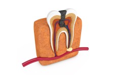 What is Tooth Root Caries?