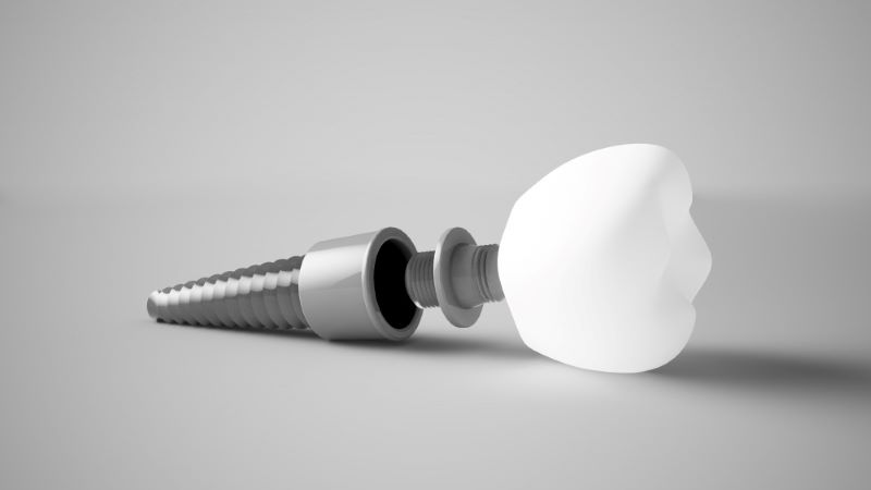 Dental İmplants In Istanbul