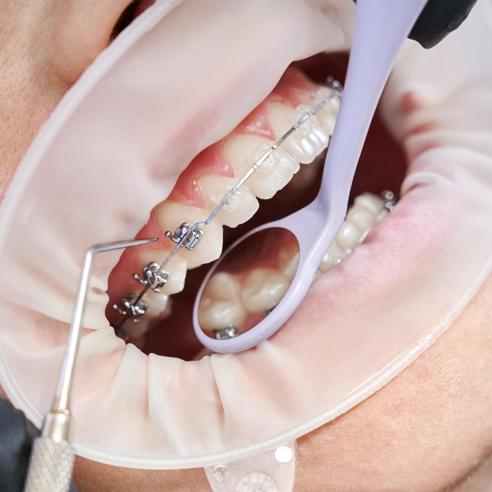 Factors That Can Damage Braces